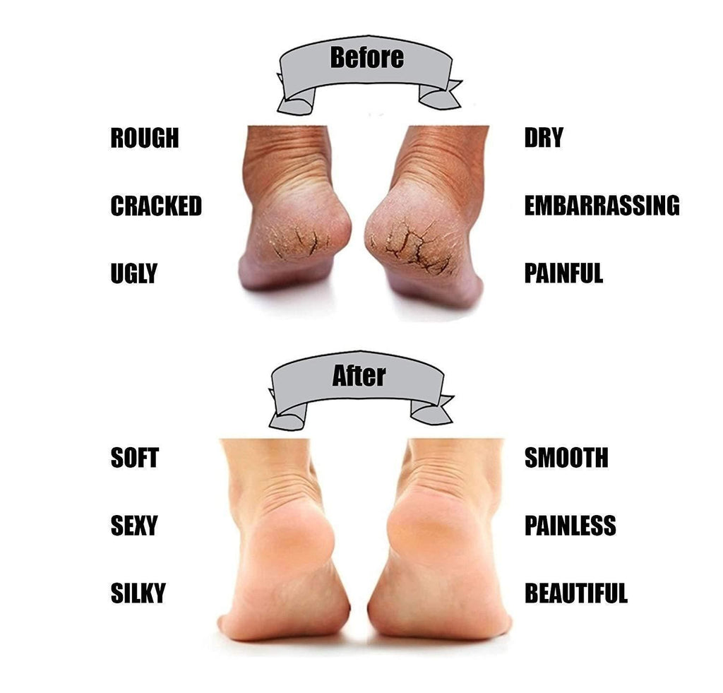 Silicon Gel Pad Heel Protector Socks - Fectorect.com